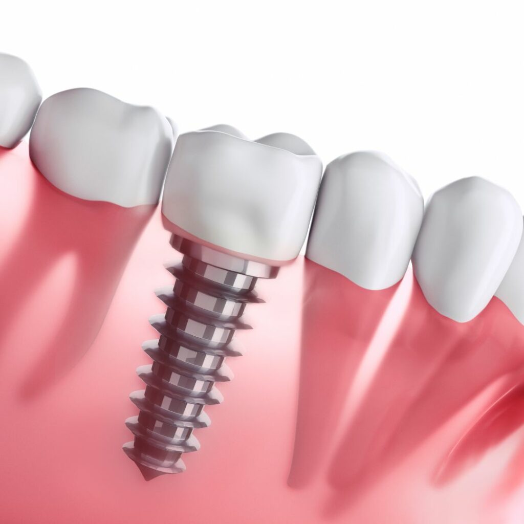 dental implant example with root in gum