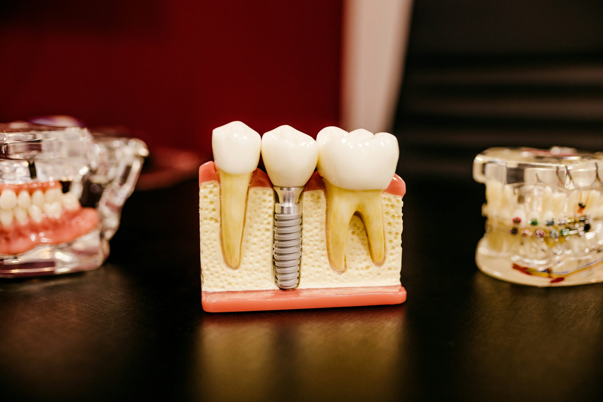 How Long Do Dental Implants Last?