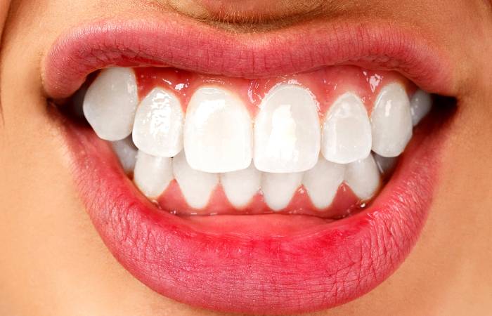 Teeth Grinding