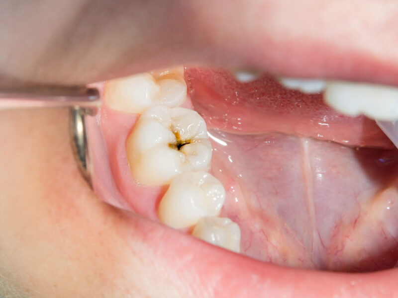 A Patient’s Guide to Tooth Wear