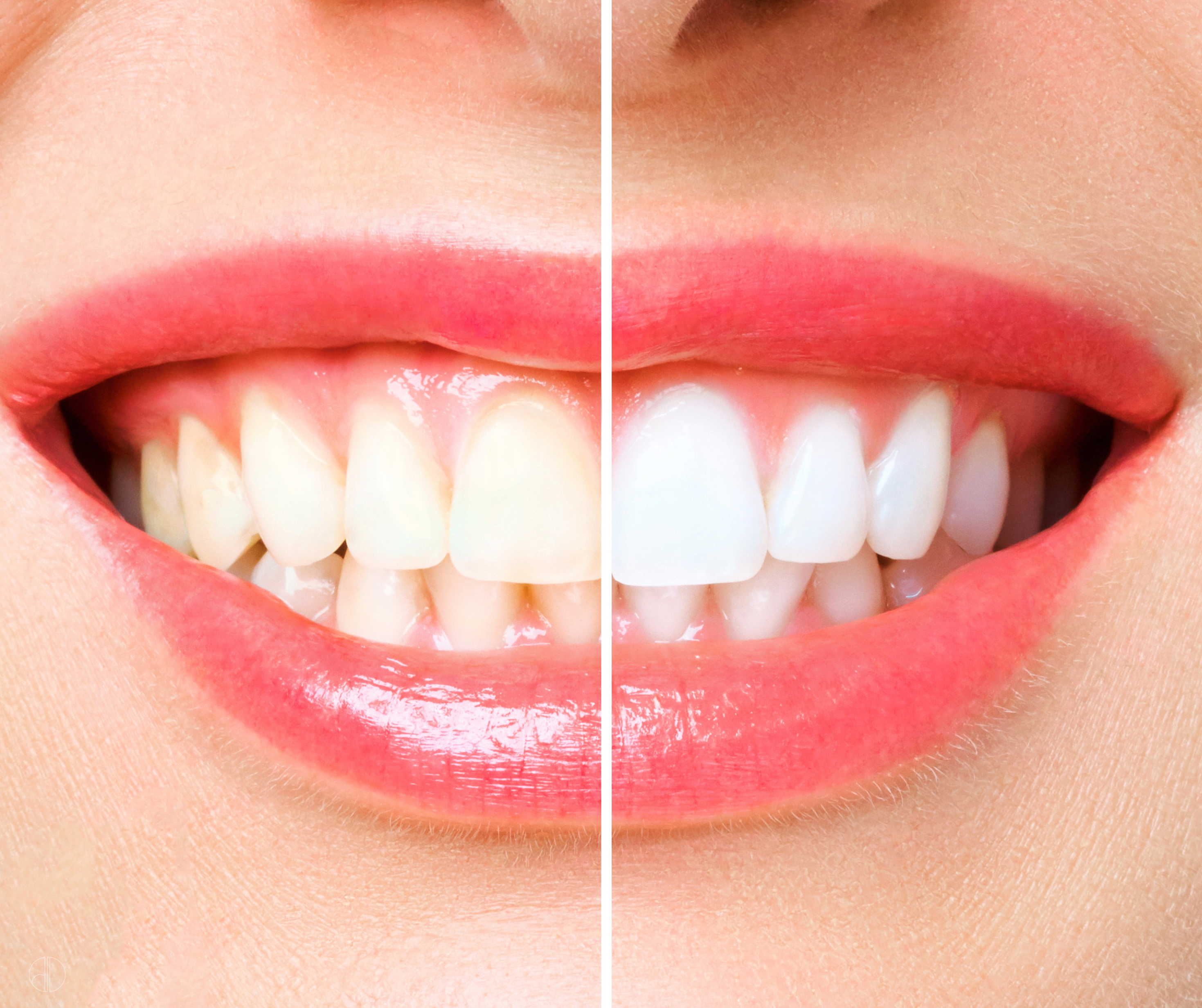 Get Summer-Ready with a Brighter Smile: Professional Tooth Whitening at Duthie Dental