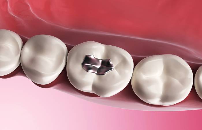 Dental Filling