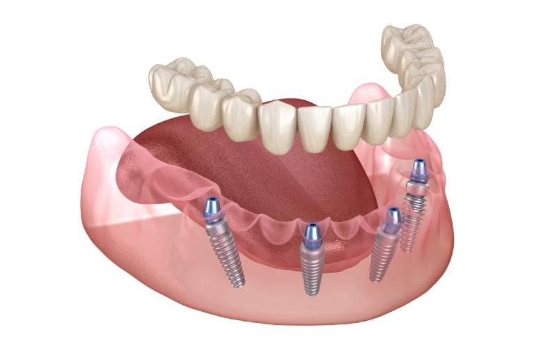 Teeth Implant