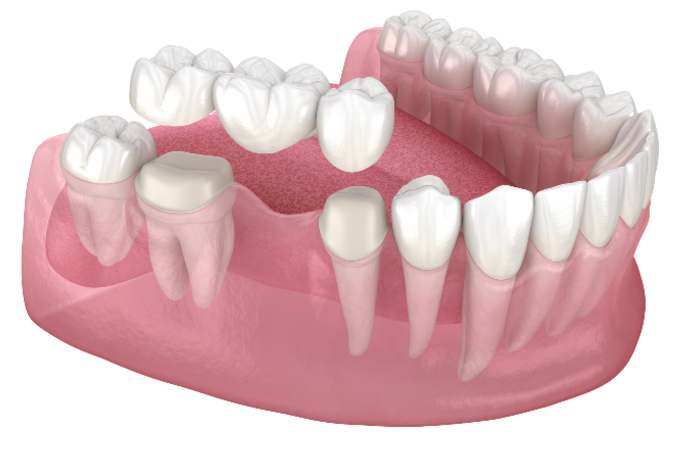 Traditional Fixed Dental Bridge
