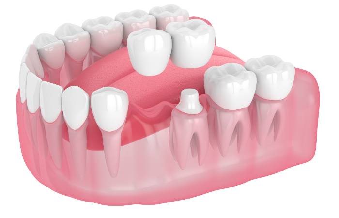 Cantilever Dental Bridge