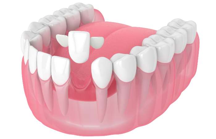 Maryland Bonded Dental Bridge