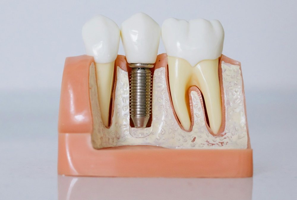 Your Complete Guide to Dental Implants in Liverpool