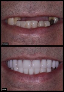 helvetic clinics abroad or dental implants in liverpool