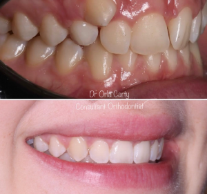 children's orthodontics in liverpool