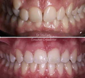 children's orthodontics in liverpool