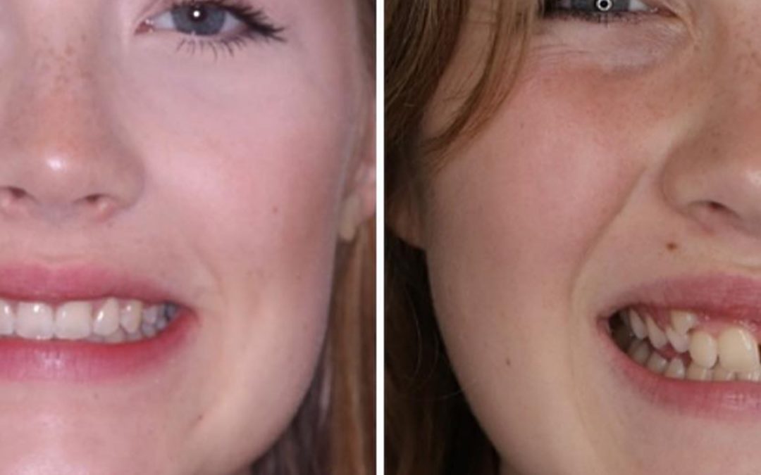 Expert Children’s Orthodontics in Liverpool: When to See a Specialist & Understanding NHS Treatment Options