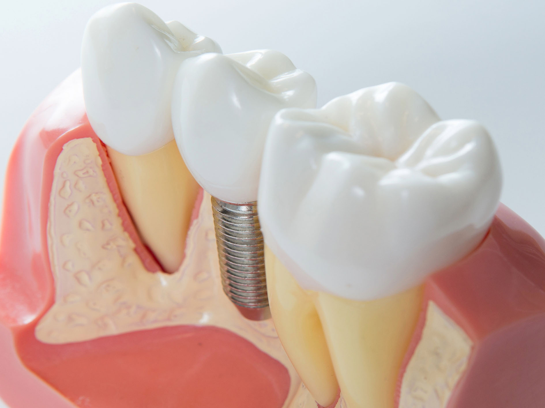 all-on-4 dental implants in liverpool