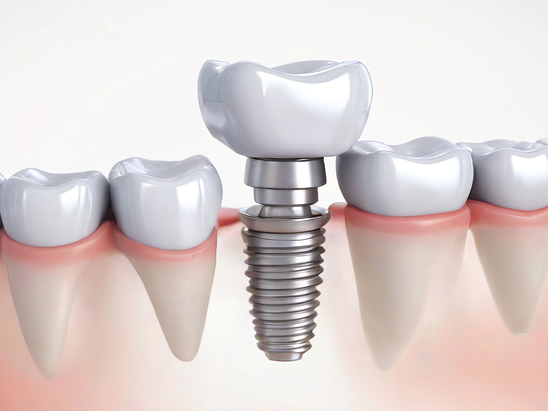 multiple dental implants in liverpool