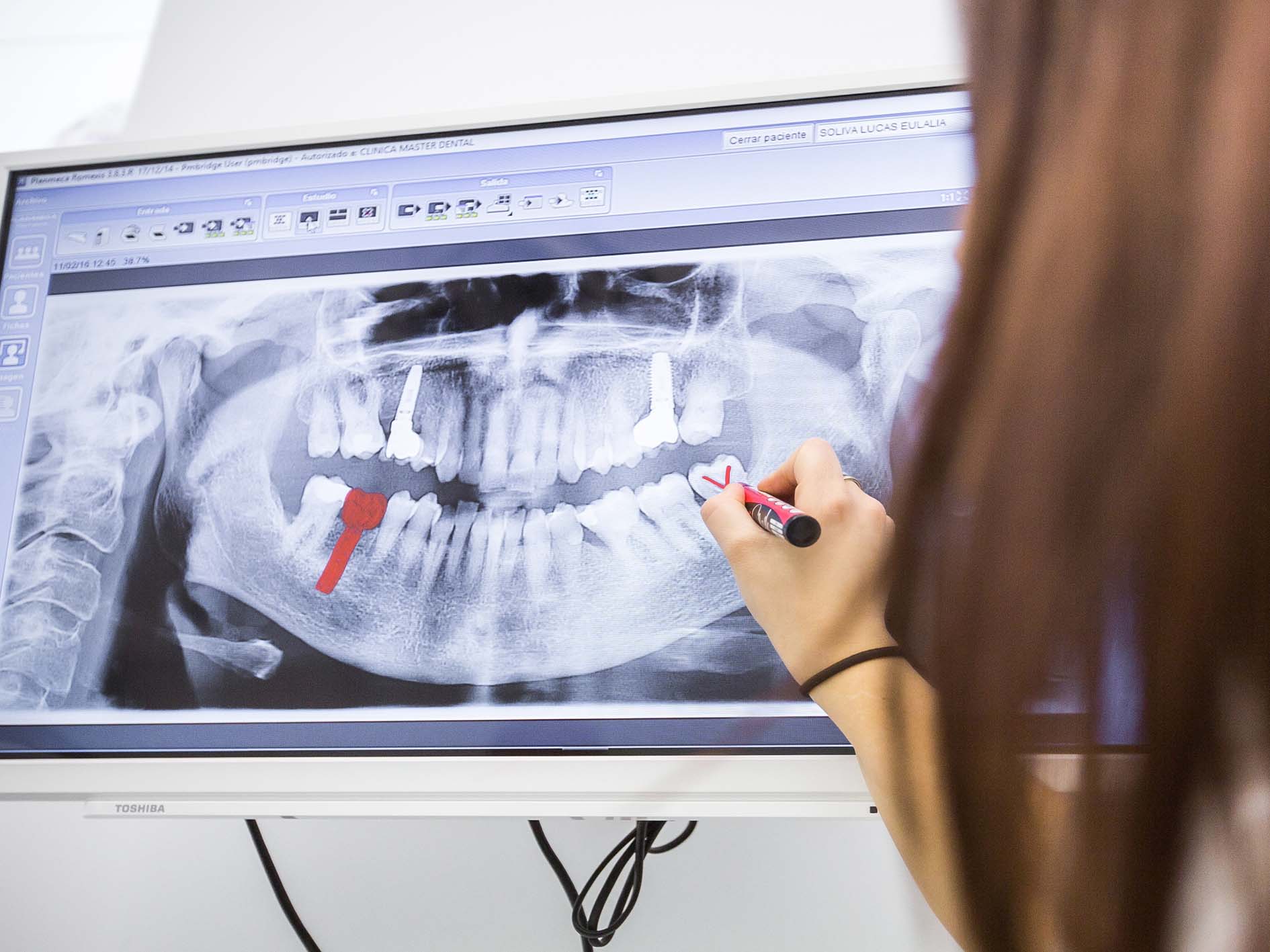 same day dental implants in liverpool