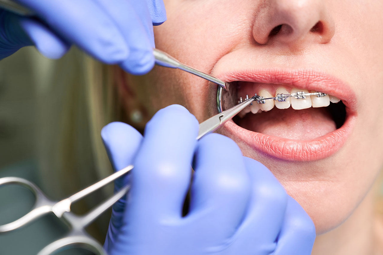 teeth straightening in liverpool