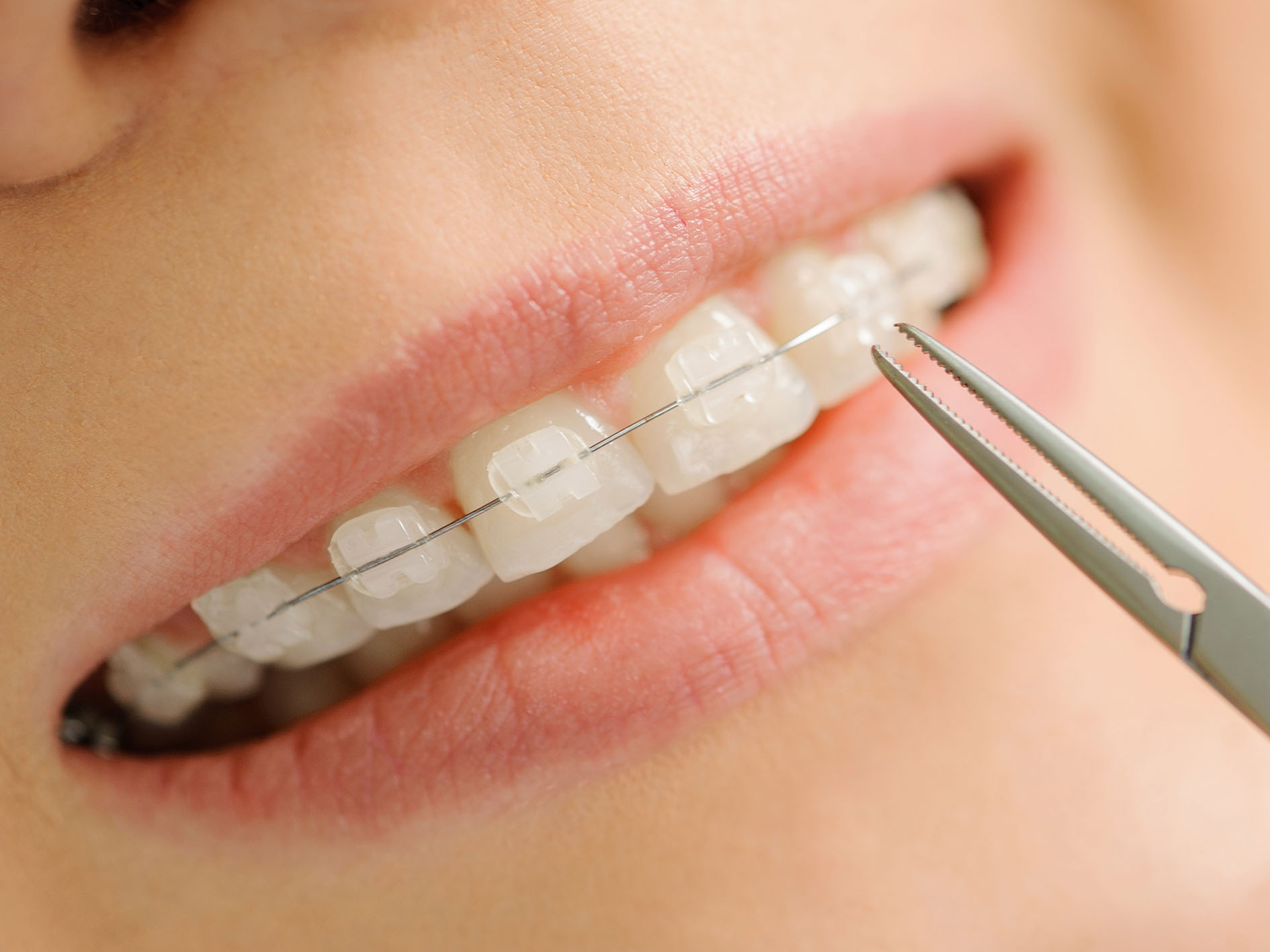 ceramic braces in liverpool