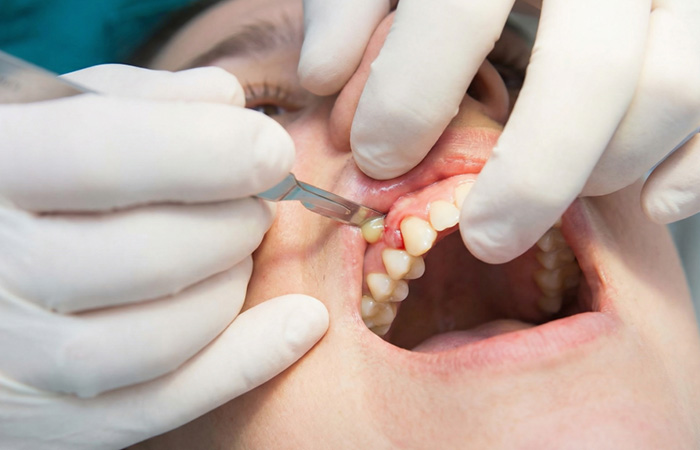 emergency tooth extraction in liverpool
