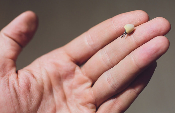 tooth fallen out in liverpool
